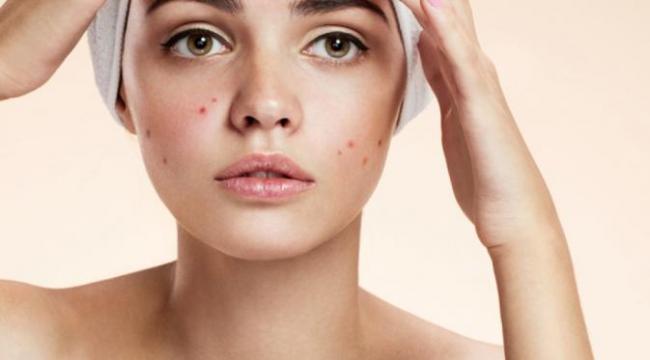 Sedang Berjerawat? Ini Tips Makeup yang Pas Untukmu Ladies!